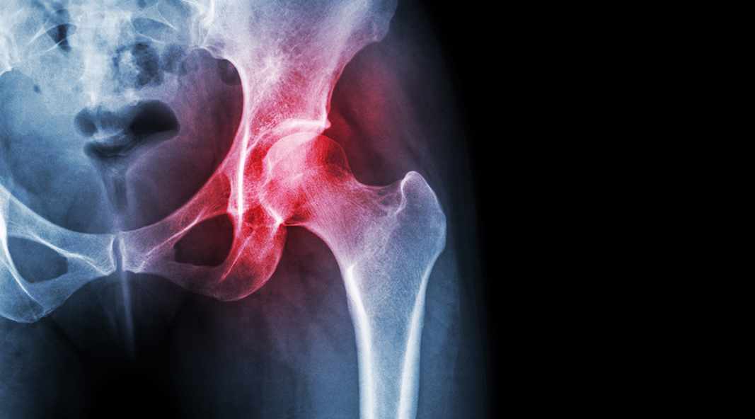 Internal Snapping Hip Syndrome