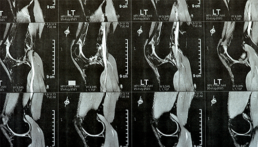 MRI of left knee joint showing minimal joint effusion, PHMM Posterior Horn Medial Meniscus degeneration, ACL anterior cruciate ligament mild sprain, normal MCL, LM, LCL, ligaments, vessels and nerves