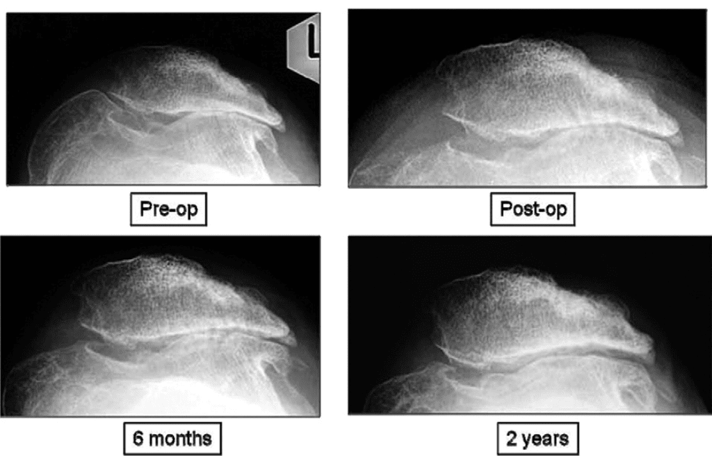 A 34-year-old woman (Fig 3) with recurrent dislocation of her patella as an adolescent. Immediate postoperative radiographs showed evidence of subchondral drilling, whereas radiographs at 6 months and 2 years showed a progressive reappearance of the lateral patellofemoral articulation.
