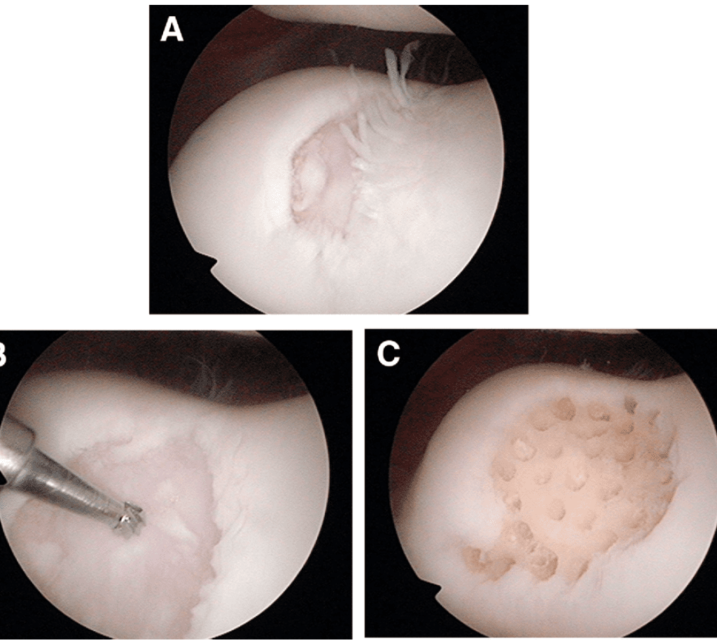 Articular Cartilage Regeneration With Autologous Peripheral Blood Progenitor Cells and Hyaluronic Acid After Arthroscopic Subchondral Drilling: A Report of 5 Cases With Histology
