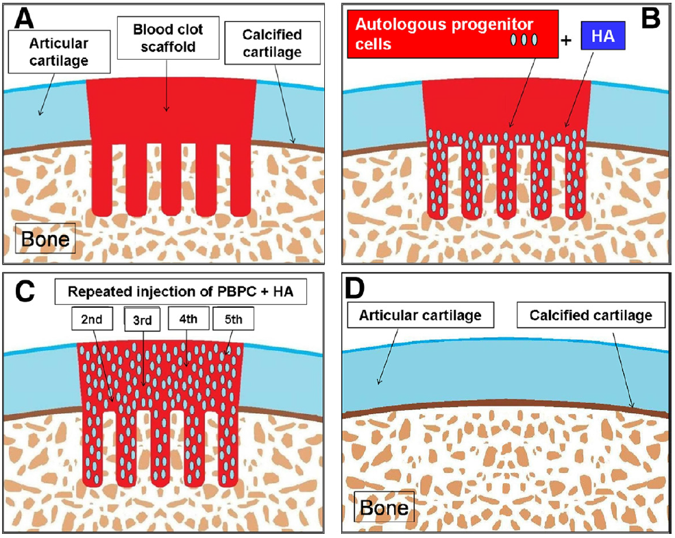 Chondrogenesis: Contained lesion. (A) A blood clot scaffold is formed after subchondral drilling and abrasion chondroplasty between the drill holes. The surrounding articular cartilage is normal with the underlying calcified cartilage layer and subchondral bone. (B) Injection of fresh PBPCs plus HA 1 week after surgery results in the homing of the PBPCs into the blood clot scaffold. (C) The PBPCs residing in the osteochondral junction and blood clot scaffold gradually transform to chondrocytes. HA helps to reduce inflammation and provide raw material for chondrogenesis. The injected PBPCs exert paracrine effects and recruit in situ progenitor cells to assist in chondrogenesis. Repeated injections of PBPCs plus HA enable more cells to be recruited into the chondral defect and enhance chondrogenesis. (D) The final result is the formation of a new layer of articular cartilage with good integration to the surrounding tissues. The ossification of the chondrocytes below the articular cartilage results in repair of the subchondral bone with re-establishment of the calcified cartilage layer.