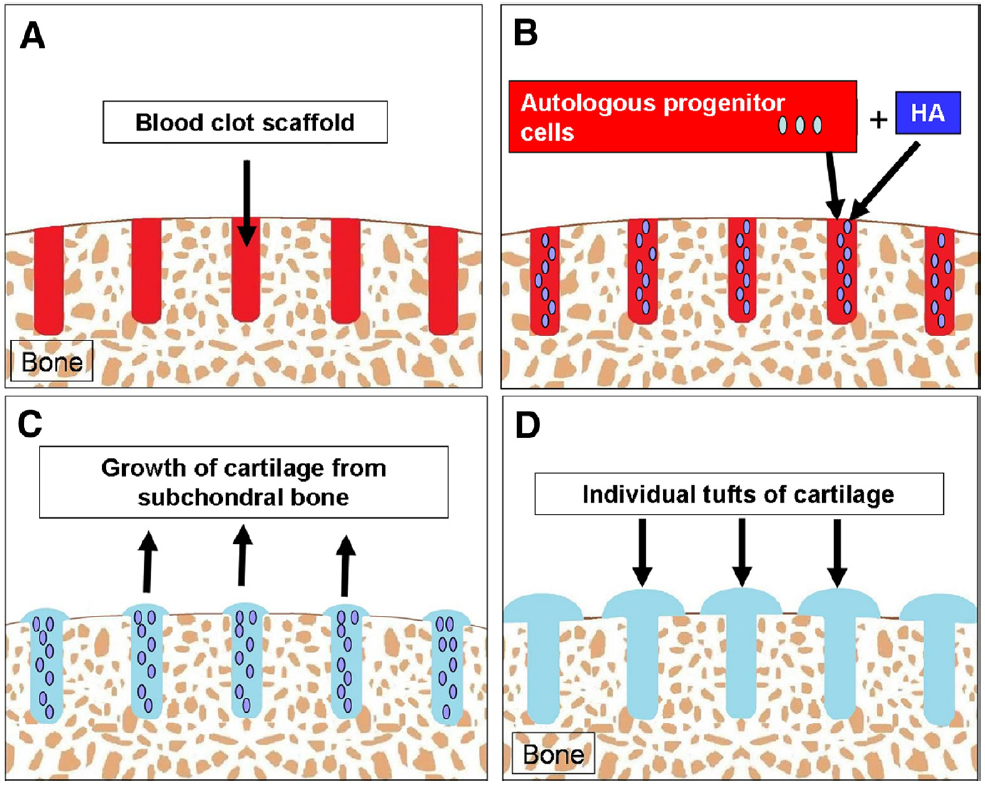 Chondrogenesis: Uncontained lesion—sparse drilling. (A) In large chondral defects with areas of bare bone, the only available blood clot scaffold is from the areas after subchondral drilling. (B) Injection of fresh autologous PBPCs plus HA 1 week after surgery will result in the homing of the PBPCs into the subchondral blood clot scaffold, with the PBPCs residing in the blood clot scaffold. (C) Because there is no blood clot scaffold superficial to the subchondral bone, chondrogenesis can only be achieved by the protruding tufts of cartilage from the subchondral bone drilling. (D) If the subchondral drill holes are placed too far apart, the end result is the incomplete coverage of the subchondral bone with individual tufts of cartilage seen between areas devoid of cartilage.