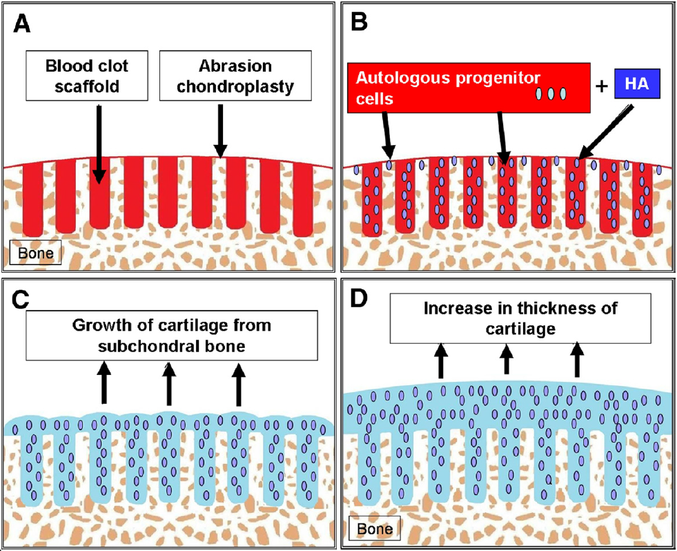 Chondrogenesis: Uncontained lesion—ideal drilling. (A) Ideally placed subchondral drilling (1 to 2 mm apart) and abrasion chondroplasty between the drill holes increase the available bony areas for the homing of the PBPCs.