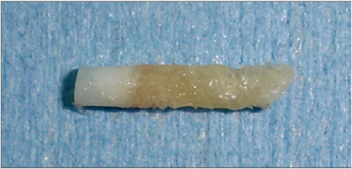 Solid articular cartilage core biopsy.