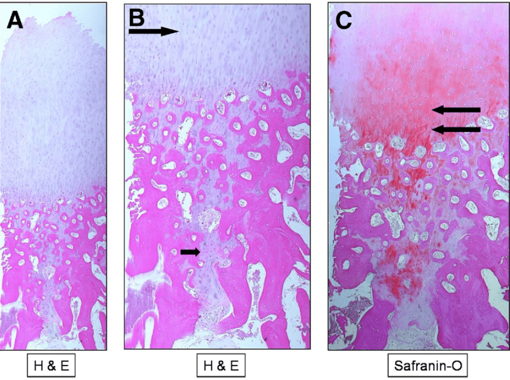 H&E sample as in Fig 5 from the medial tibial plateau obtained by biopsy of area of previous drilling.
