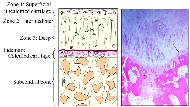 A biopsy specimen from the medial femoral condyle illustrating ossification of regenerated cartilage and the re-establishment of the calcified cartilage (white arrow) layer with tidemark (black arrow).