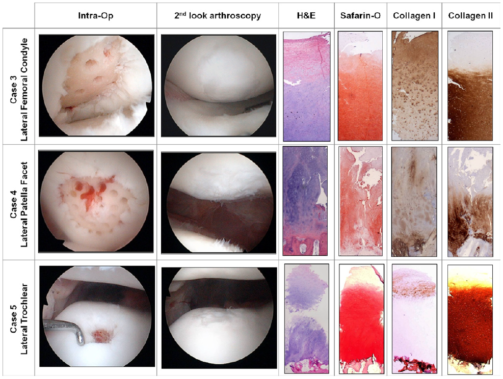 FIGURE 9. Second-look arthroscopy and histologic images of a lesion from the lateral femoral condyle (case 3), a lesion from the lateral patella facet (case 4), and a lesion from the lateral trochlear area (case 5). (Original magnification  40.)
