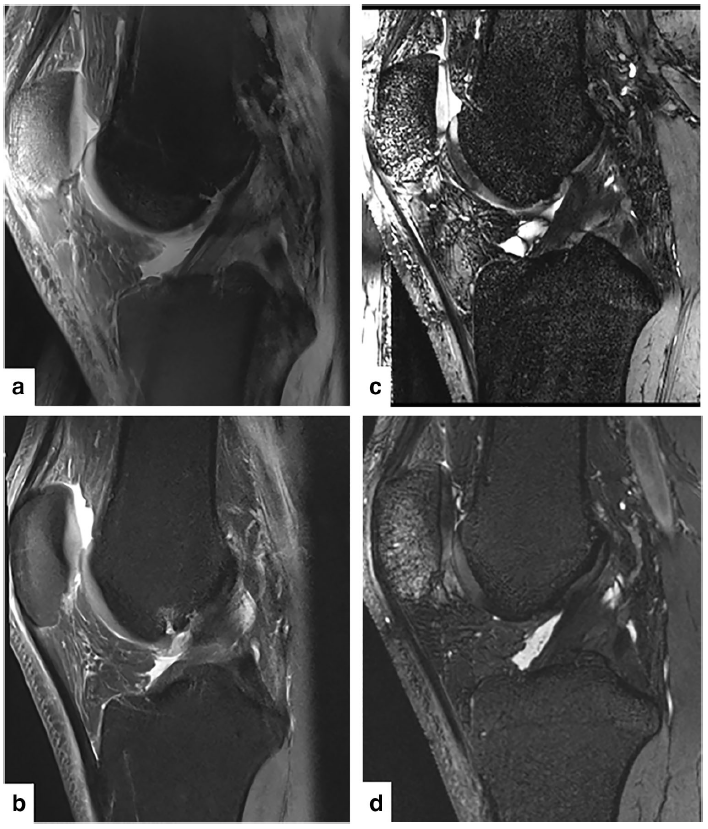 MRI scan on one knee with a 3-T scanner and a 7-T scanner.