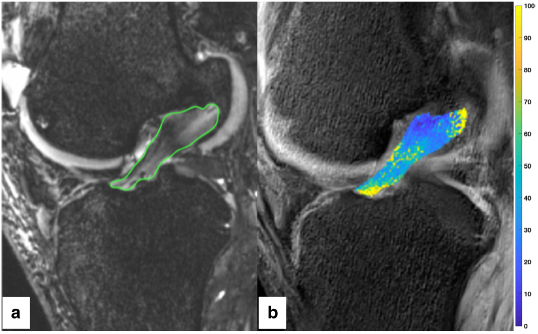 a Segmenting was performed by circumscribing the ACL on each slice of the sagittal TRUFI 3D sequence for each scan, creating a region of interest. This was repeated for each image in the sagittal TRUFI 3D sequence creating a 3D region of interest. b The 3D region of interest was transferred to the T2 mapping images. The color bar scale on the right shows the distribution of T2 values