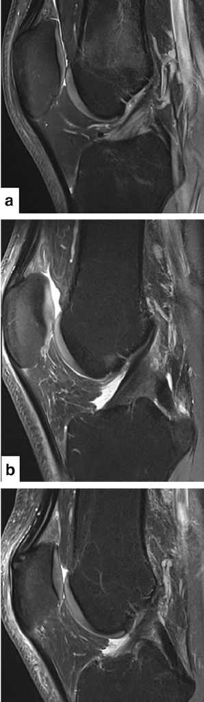 Sagittal PD TSE FS images
