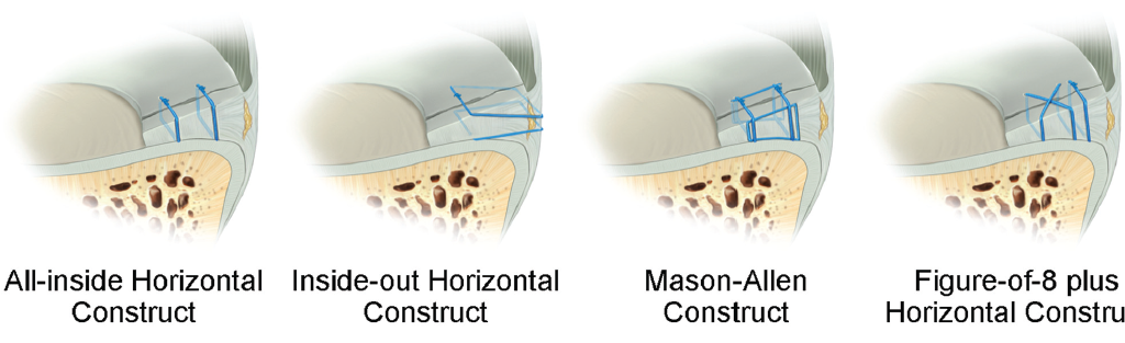 Biomechanical Comparison of Arthroscopic Repair Constructs for Radial Tears of the Meniscus