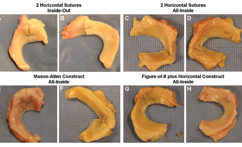 (A, B) The inside-out horizontal construct. (C, D) The all-inside horizontal construct. (E, F) The Mason-Allen construct. (G, H) The figure-of-8 plus horizontal construct. Panels A, C, E, and G illustrate the femoral view of constructs, and B, D, F, and H illustrate the tibial view of constructs.
